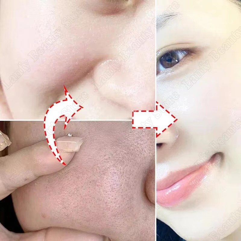 Крем с салициловой кислотой дл – обзор и цена Salicylic Acid Blackhead Remover