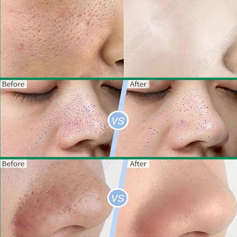 Крем с салициловой кислотой дл – обзор и цена Salicylic Acid Blackhead Remover
